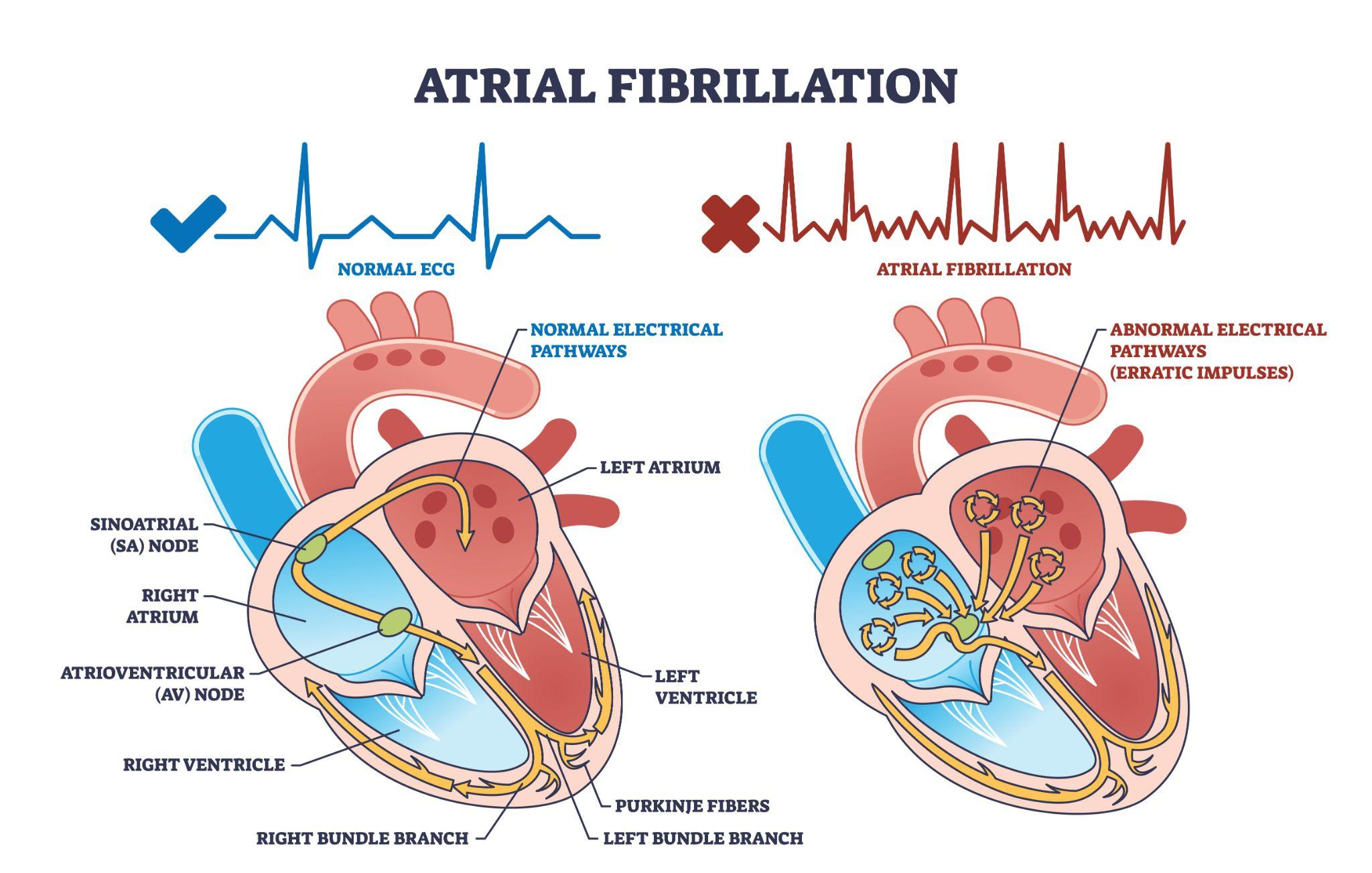 Atrial.png