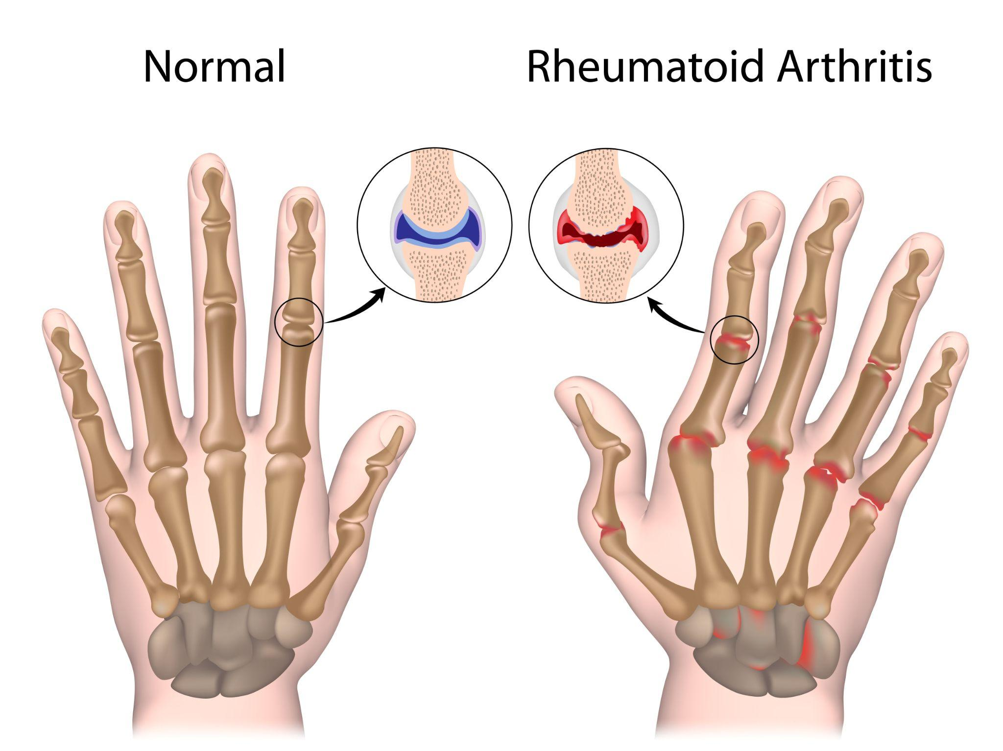 Arthritis.png