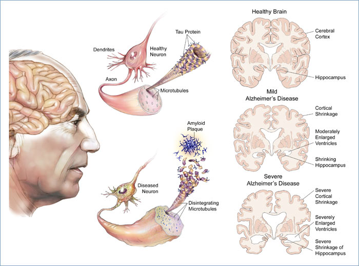 alzheimers-disease