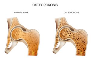 bigstock-Osteoporosis-44323384.jpg