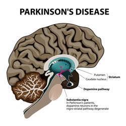 Parkinsons-III.jpg