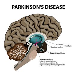 Parkinsons-III.jpg Parkinsons-III.jpg