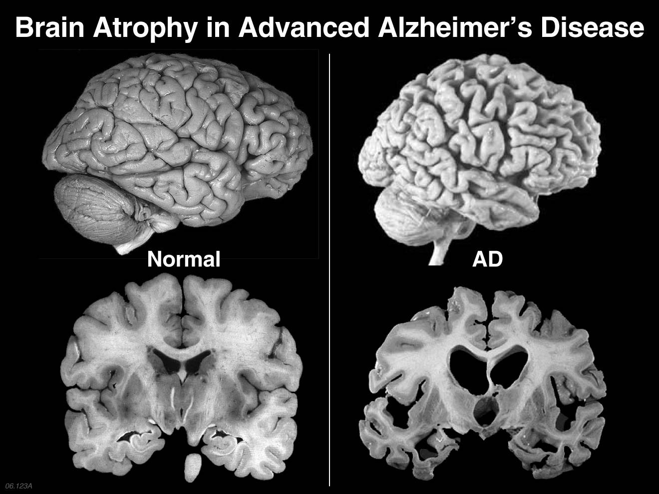 alzheimers scan